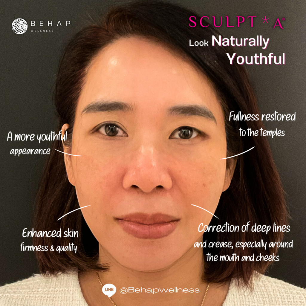 Sculptra Result