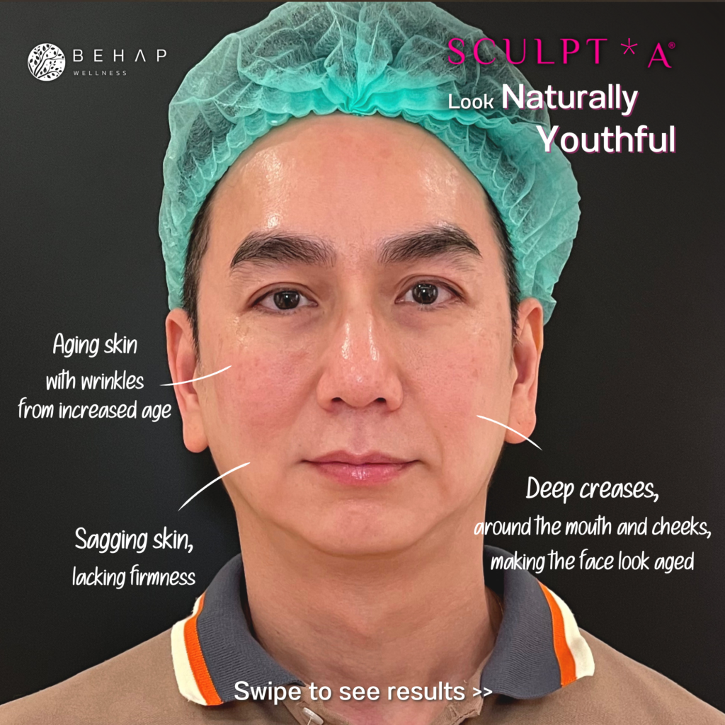 Sculptra Result