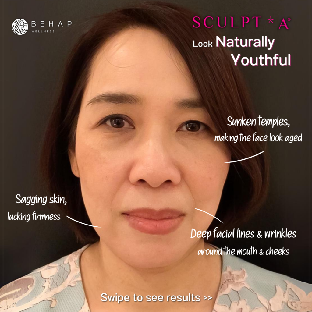 Sculptra Result