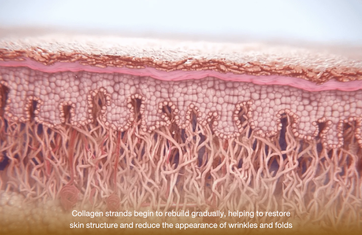 how sculptra works 3