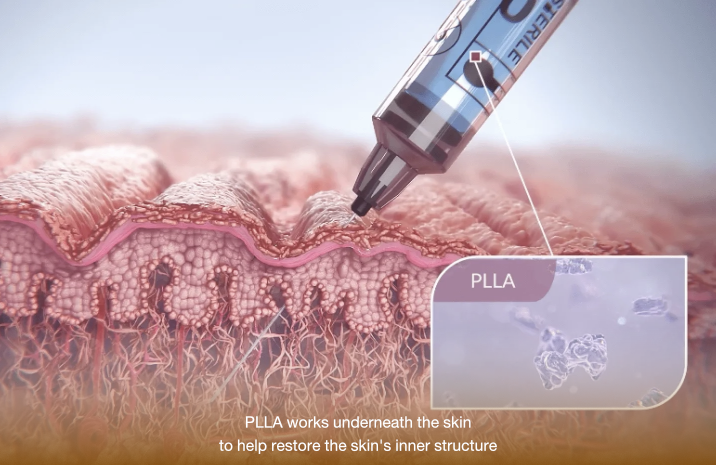 how sculptra works
