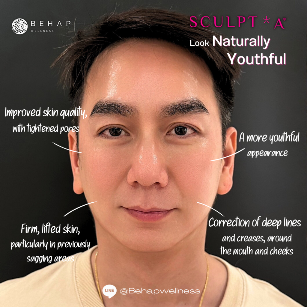 Sculptra Result