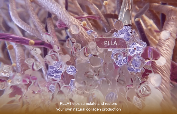 how sculptra works 2