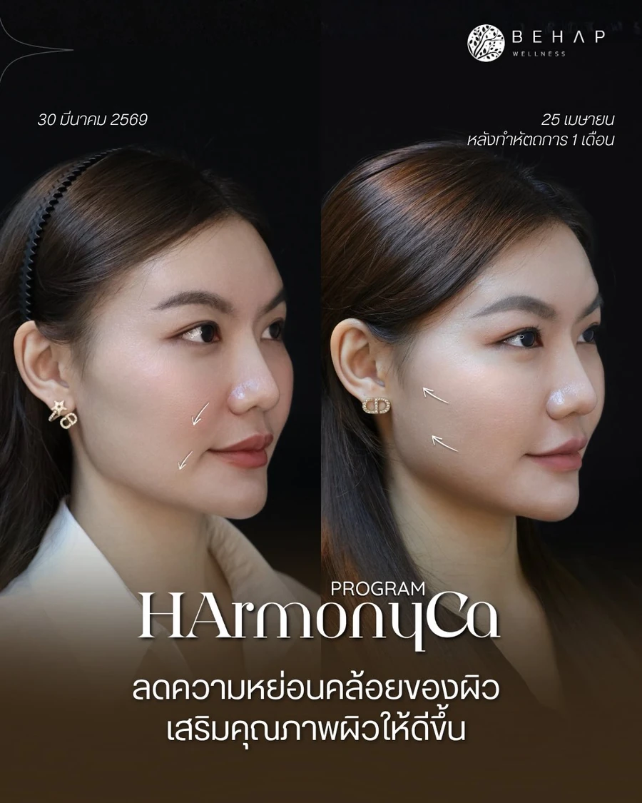 ภาพต้นฉบับก่อนและหลังรับบริการโปรแกรม HArmonyCa มุมเฉียง จากโพสต์ BEHAP วันที่ 4 พฤษภาคม 2026