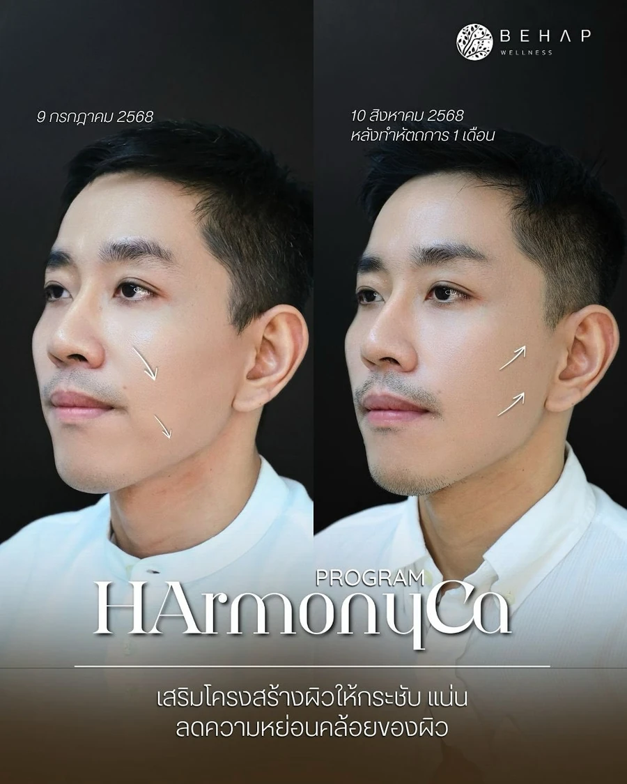 ภาพต้นฉบับก่อนและหลังรับบริการโปรแกรม HArmonyCa มุมเฉียง เคสที่ 2 วันที่ 9 กรกฎาคม ถึง 10 สิงหาคม 2568