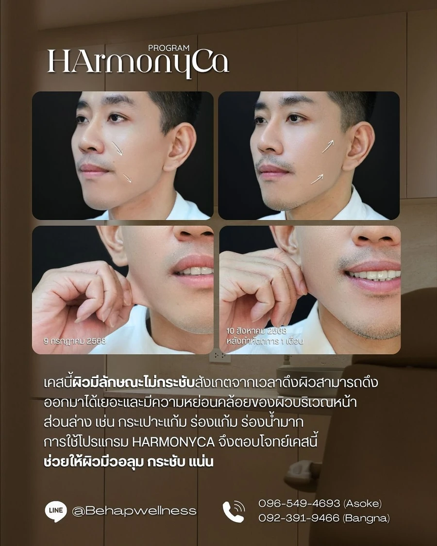 ภาพระยะใกล้และภาพติดตามผิวของผู้รับบริการโปรแกรม HArmonyCa เคสที่ 2 จากโพสต์ BEHAP วันที่ 13 ตุลาคม 2025