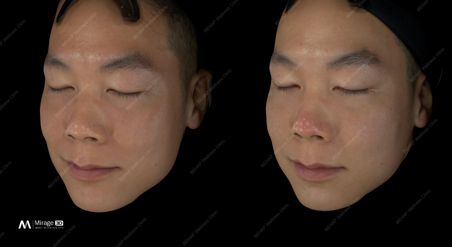 Skin overview — Before · Left / After · Right