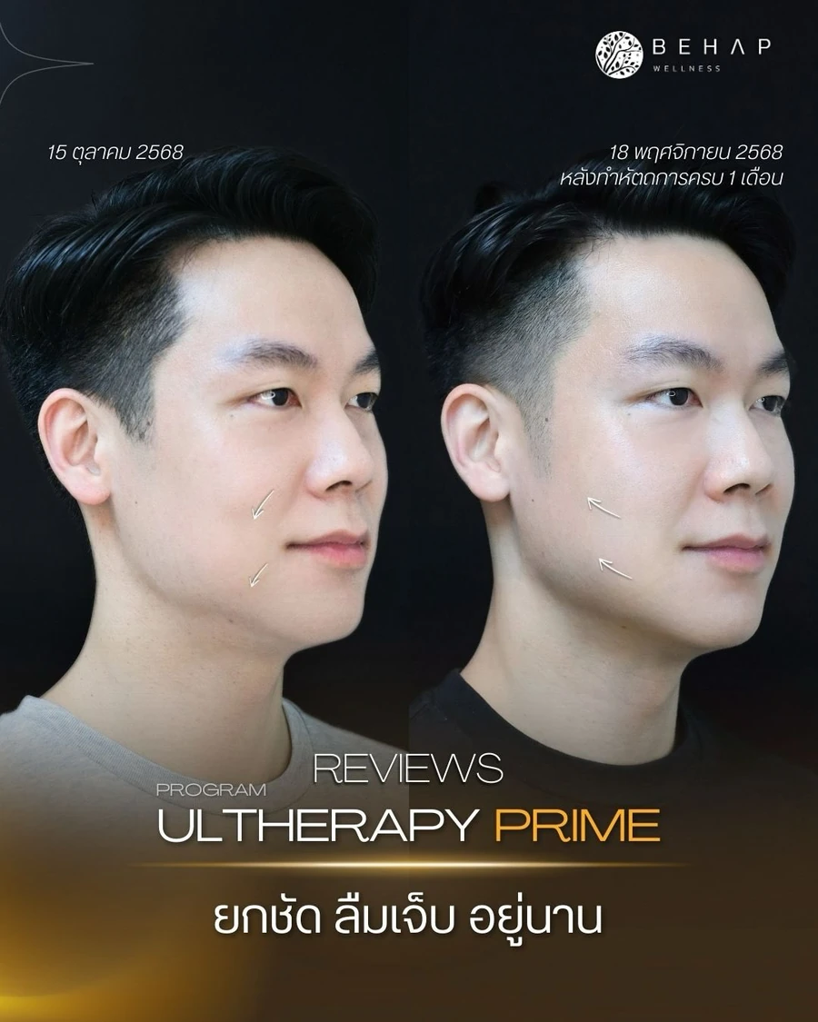 ภาพก่อนและหลังโปรแกรม Ultherapy PRIME เคสเดียวกัน มุมเฉียง วันที่ 15 ตุลาคม และ 18 พฤศจิกายน 2568 ตามภาพจาก BEHAP