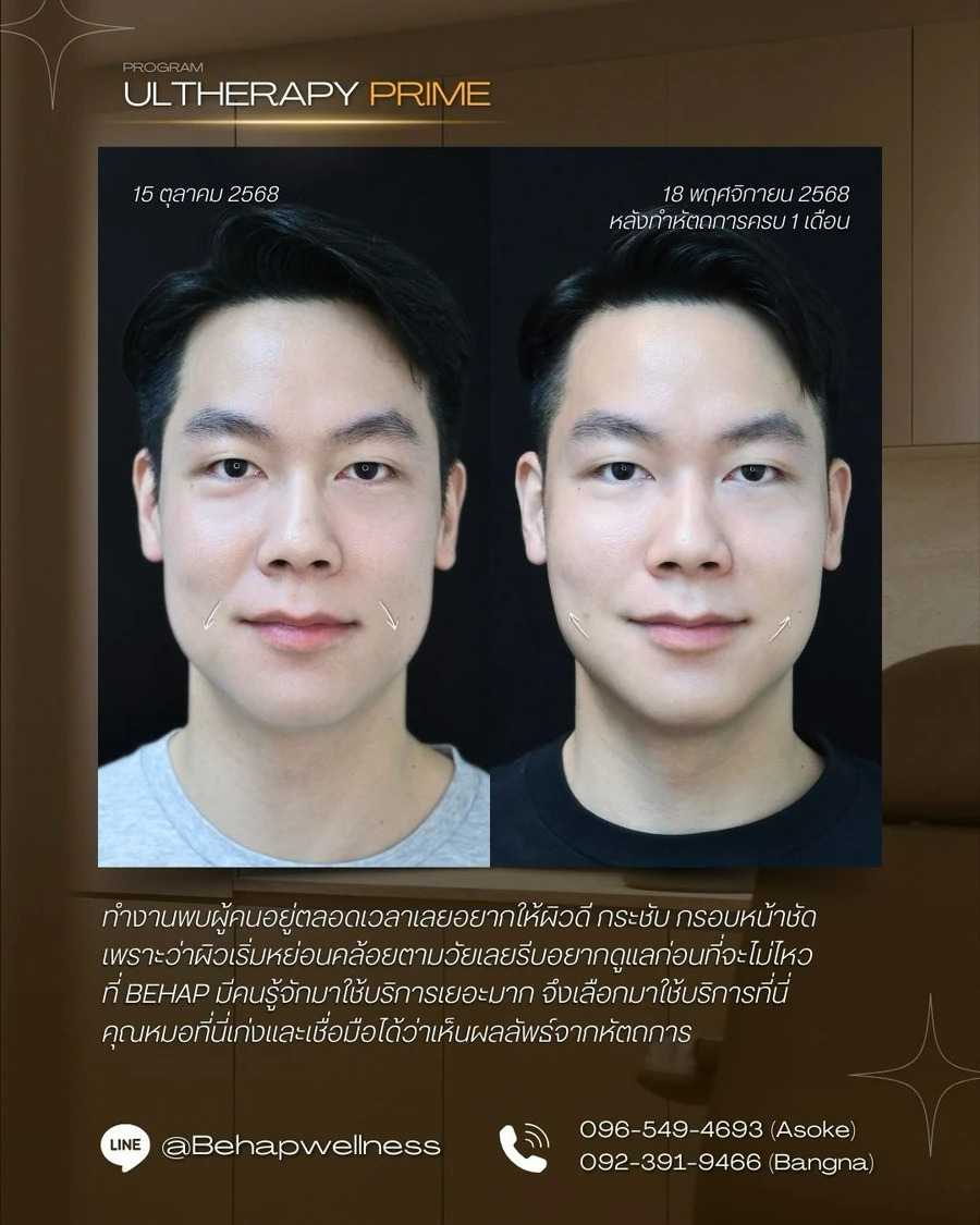 ภาพก่อนและหลังโปรแกรม Ultherapy PRIME เคสเดียวกัน มุมตรง วันที่ 15 ตุลาคม และ 18 พฤศจิกายน 2568 ตามภาพจาก BEHAP