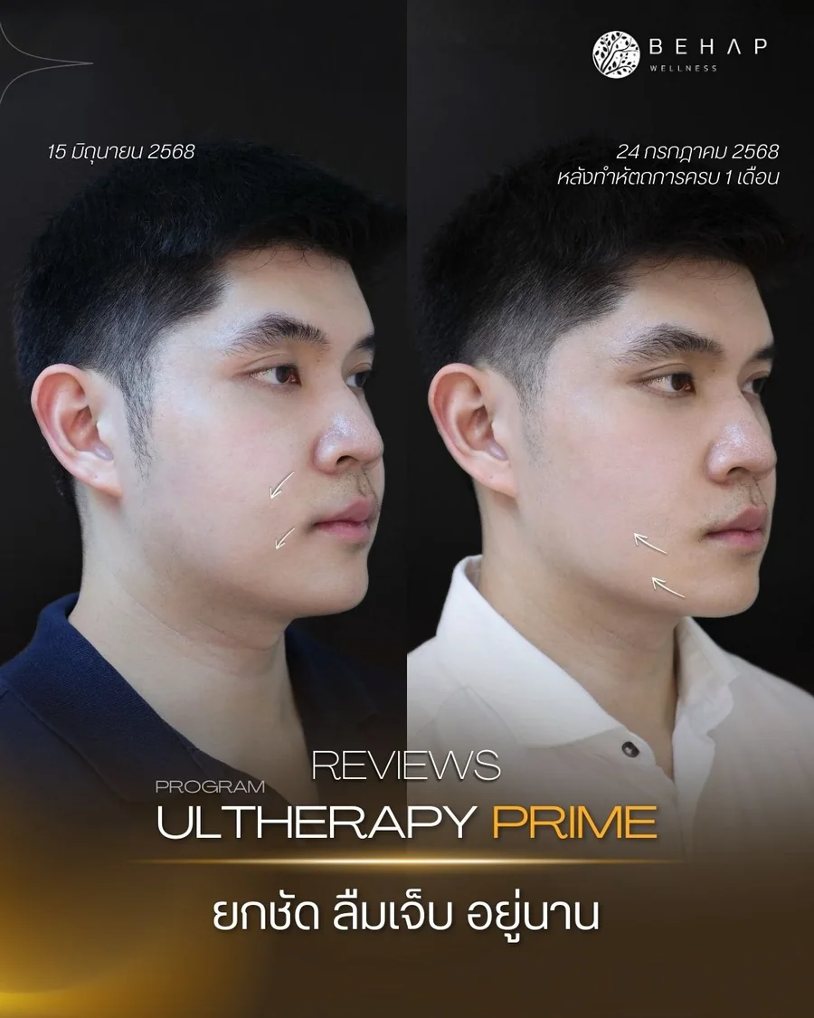 ภาพก่อนและหลังโปรแกรม Ultherapy PRIME จาก BEHAP วันที่ในภาพ 15 มิ.ย. — 24 ก.ค. 2568