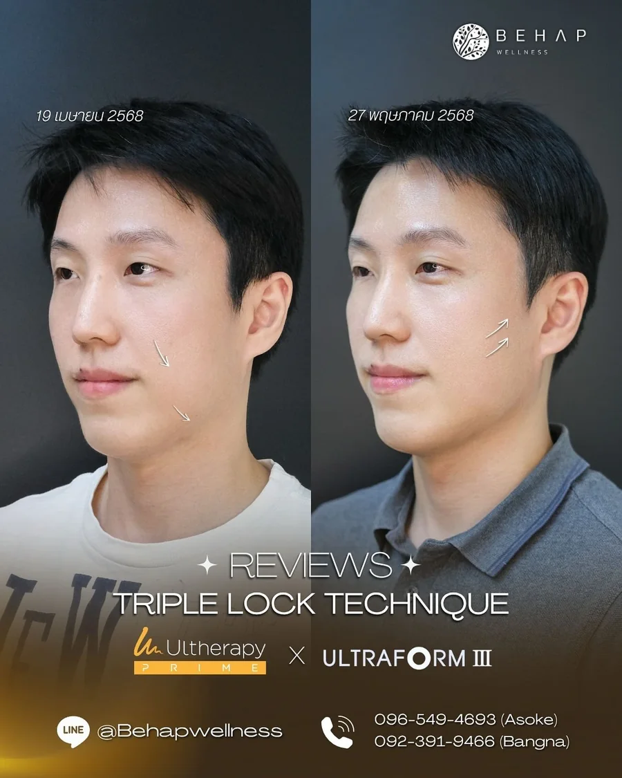 ภาพก่อนและหลังโปรแกรม Ultherapy PRIME + Ultraformer III จาก BEHAP วันที่ในภาพ 19 เม.ย. — 27 พ.ค. 2568