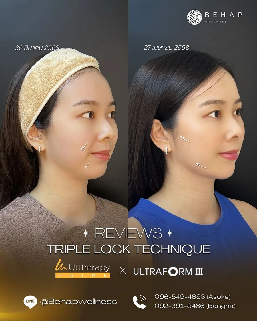 ภาพก่อนและหลังโปรแกรม Ultherapy PRIME + Ultraformer III จาก BEHAP วันที่ในภาพ 30 มี.ค. — 27 เม.ย. 2568
