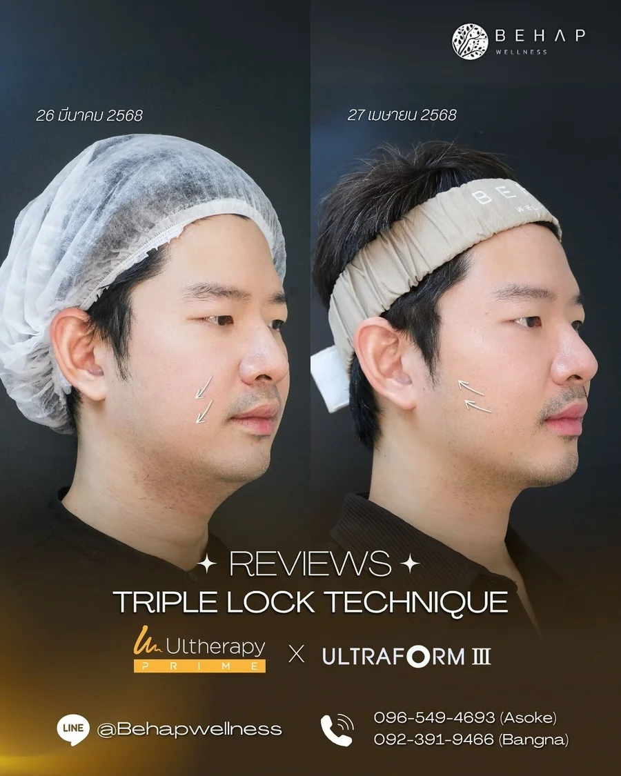 ภาพก่อนและหลังโปรแกรม Ultherapy PRIME + Ultraformer III จาก BEHAP วันที่ในภาพ 26 มี.ค. — 27 เม.ย. 2568