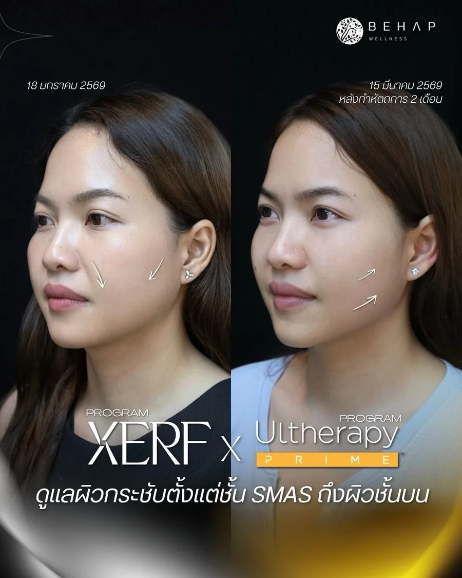 ภาพก่อนและหลังโปรแกรม Ultherapy PRIME + XERF จาก BEHAP วันที่ในภาพ 18 ม.ค. — 15 มี.ค. 2569