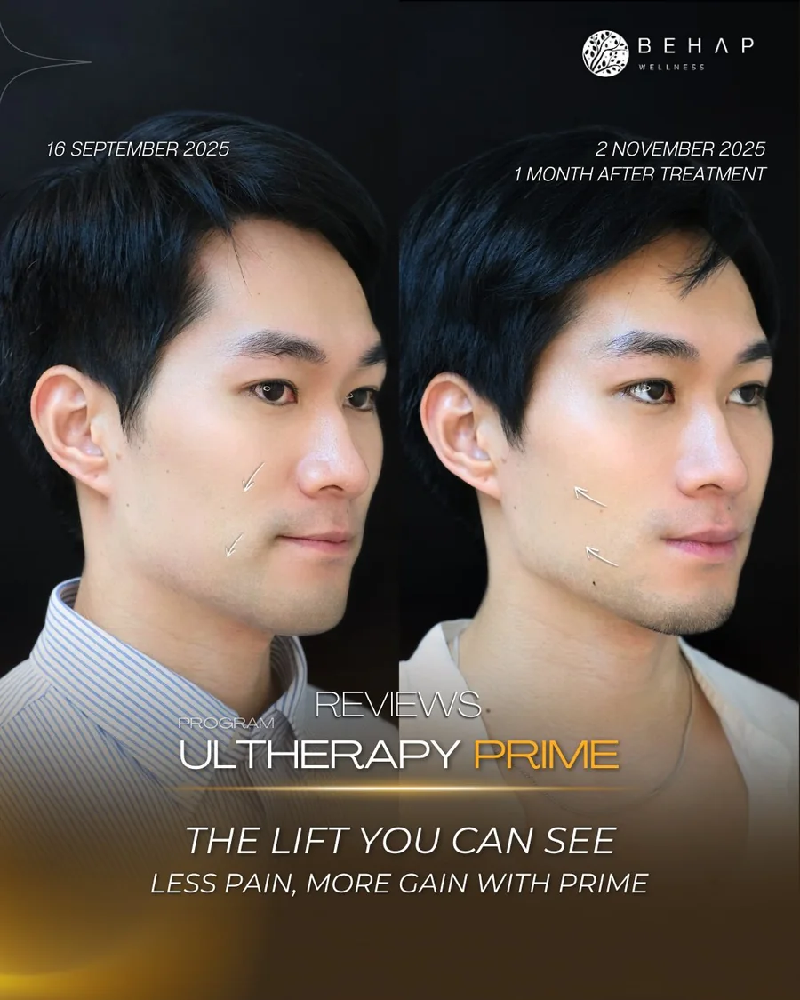 ภาพก่อนและหลังโปรแกรม Ultherapy PRIME จาก BEHAP วันที่ในภาพ 16 ก.ย. — 2 พ.ย. 2568