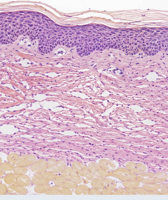 XERF treatment image