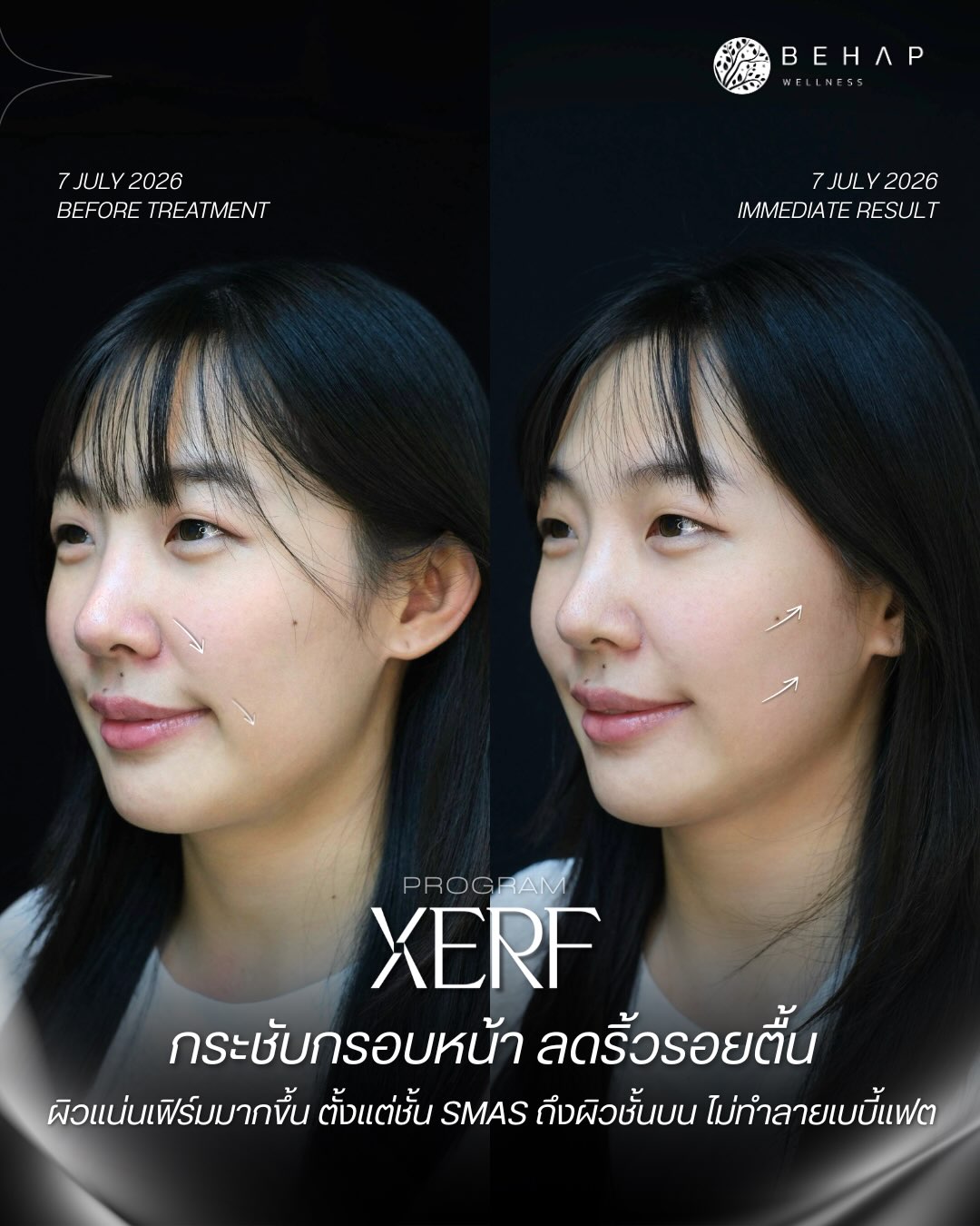 Original XERF before-and-after post from @behap.clinic: 7 Jul 2026 and 7 Jul 2026
