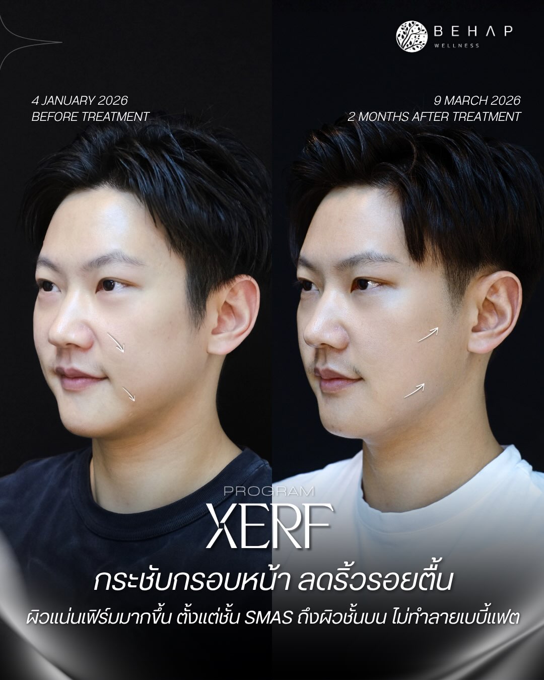 Original XERF before-and-after post from @behap.clinic: 4 Jan 2026 and 9 Mar 2026