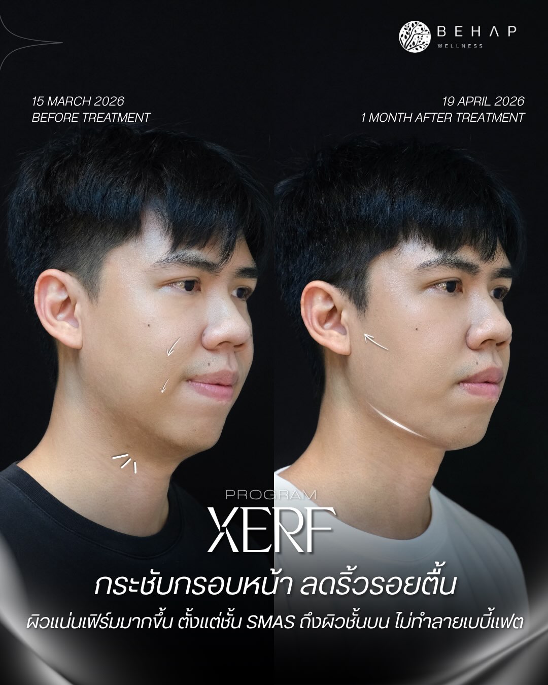 Original XERF before-and-after post from @behap.clinic: 15 Mar 2026 and 19 Apr 2026