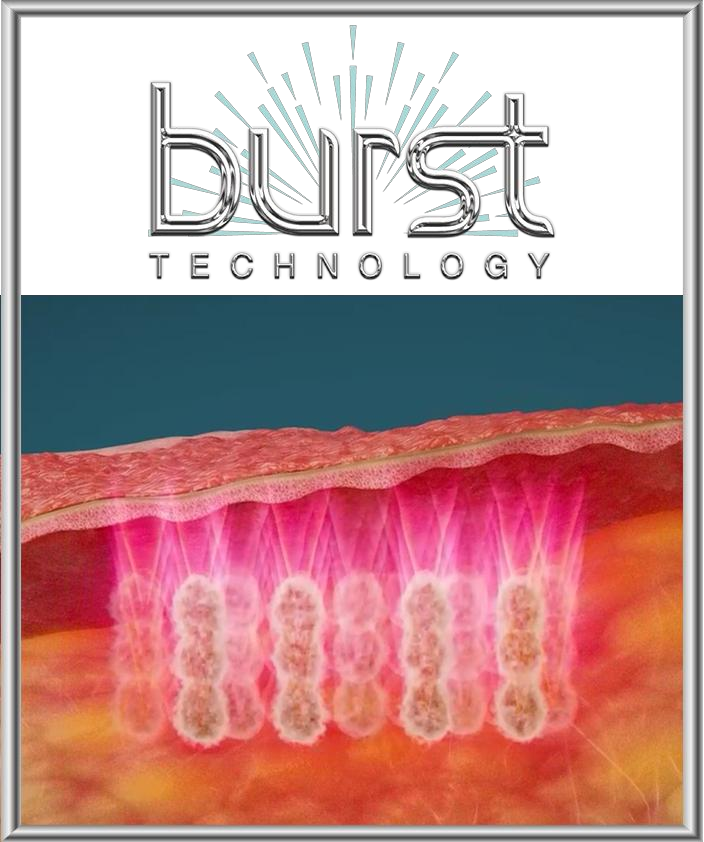ภาพจำลอง BURST แสดงการส่งพลังงานหลายระดับความลึกในตำแหน่งเดียว