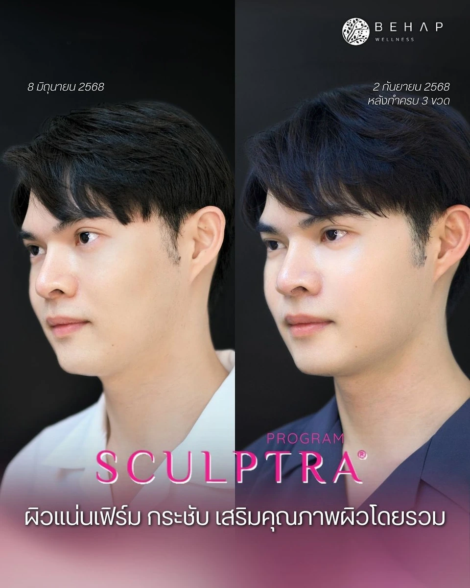 Sculptra before and after 3 vials, side view