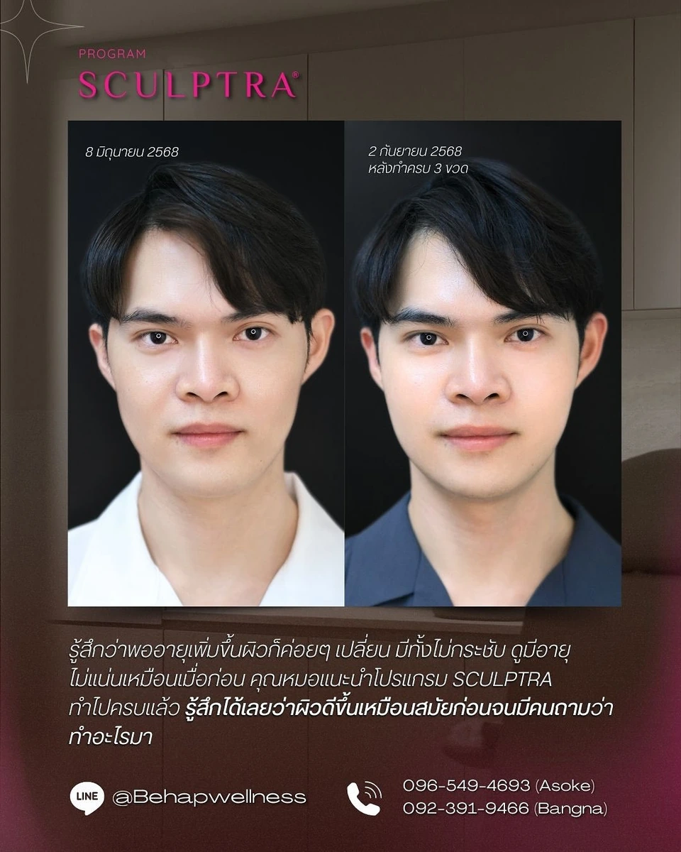Sculptra before and after 3 vials, front view and review text from the post