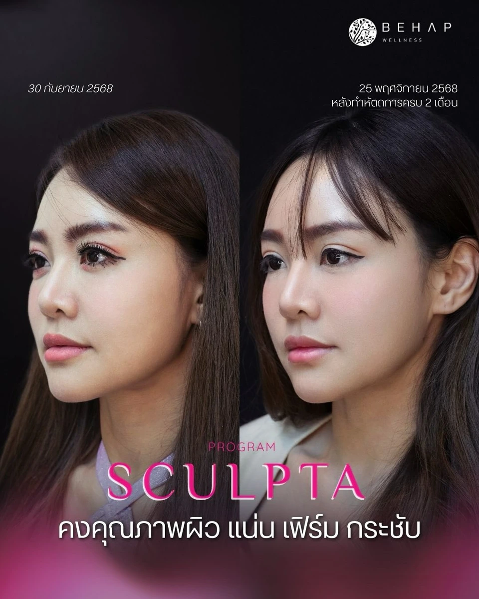 Sculptra before and after, 2-month follow-up, side view