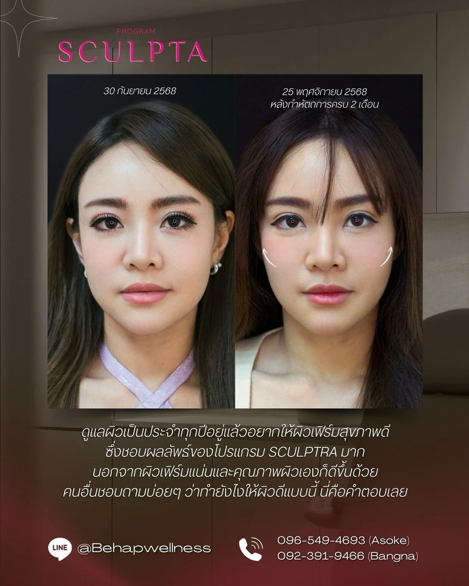 Sculptra before and after, 2-month follow-up, front view and review text from the post